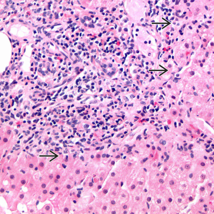Hepatitis B Clinical Gate
