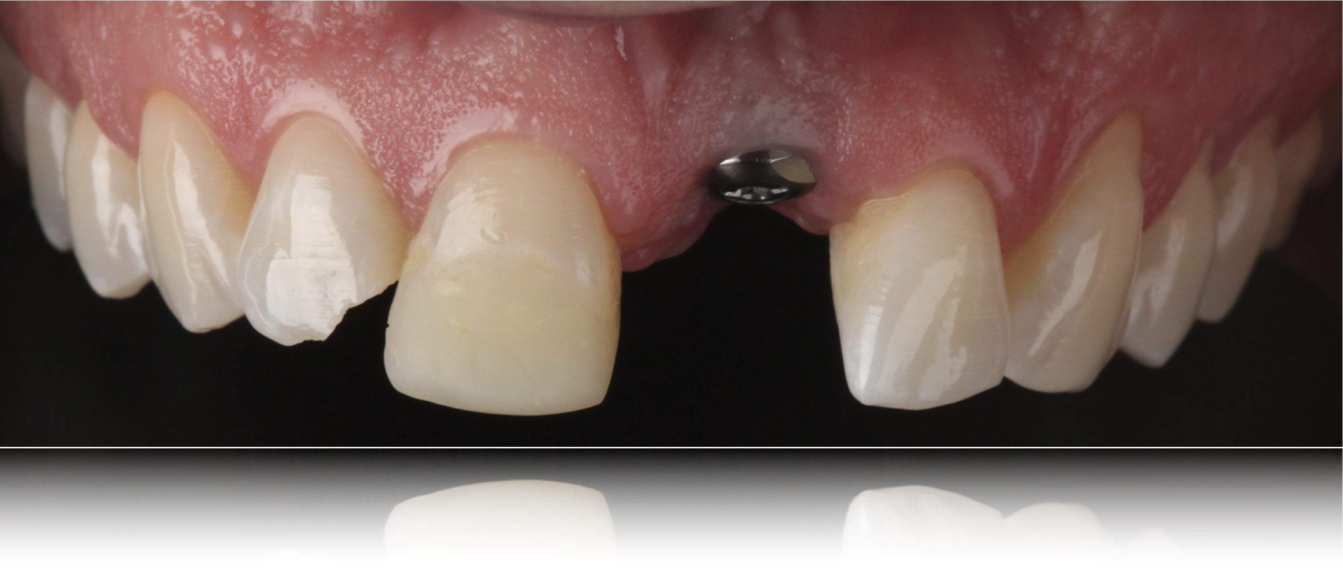 Mastering Dental Implant Restorations and Aesthetics