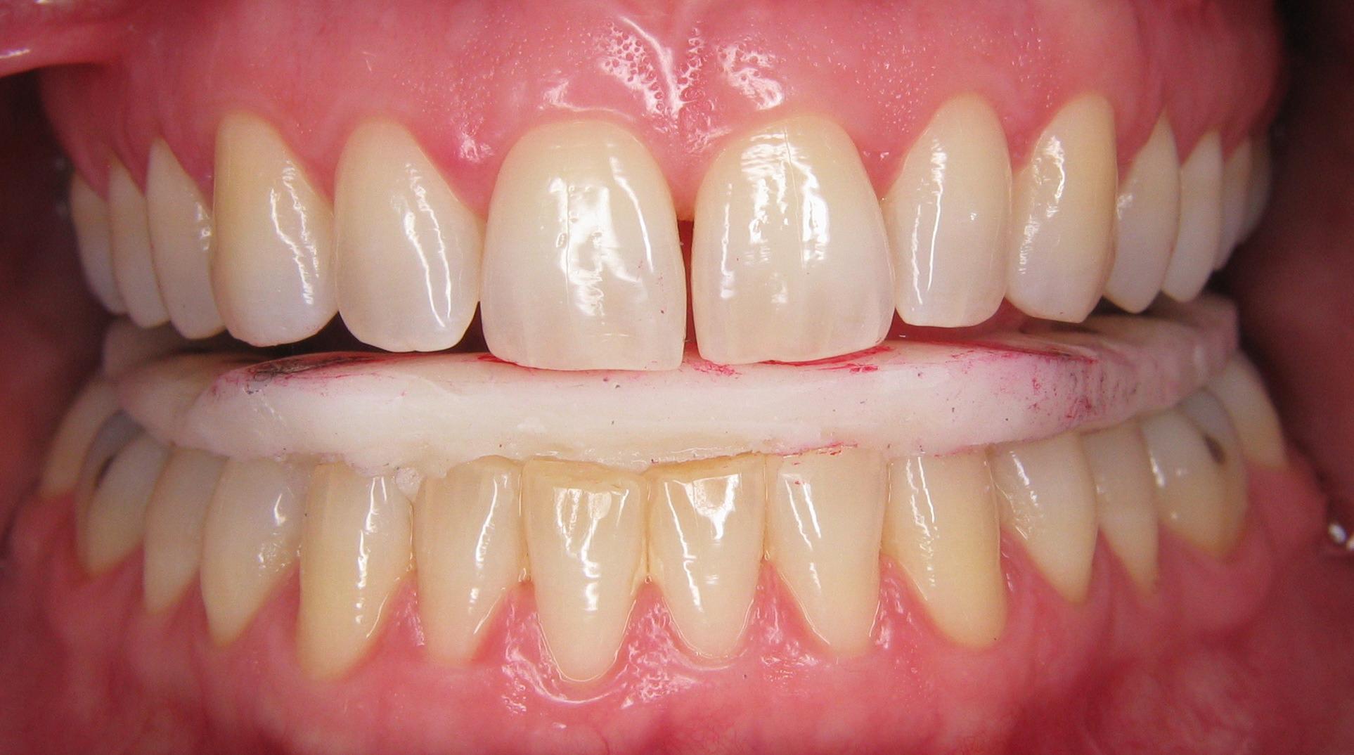 Why You Should Work With Your Patients On Appliance Therapy Part 1