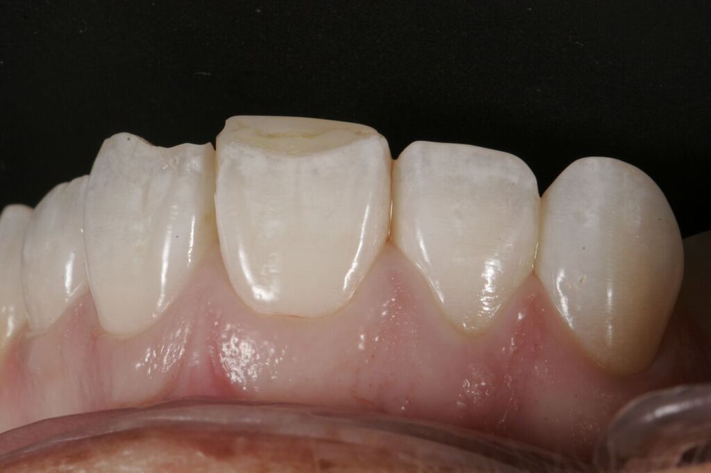Setting Up The Occlusion Ceramic Porcelain Fracture Guidelines 1