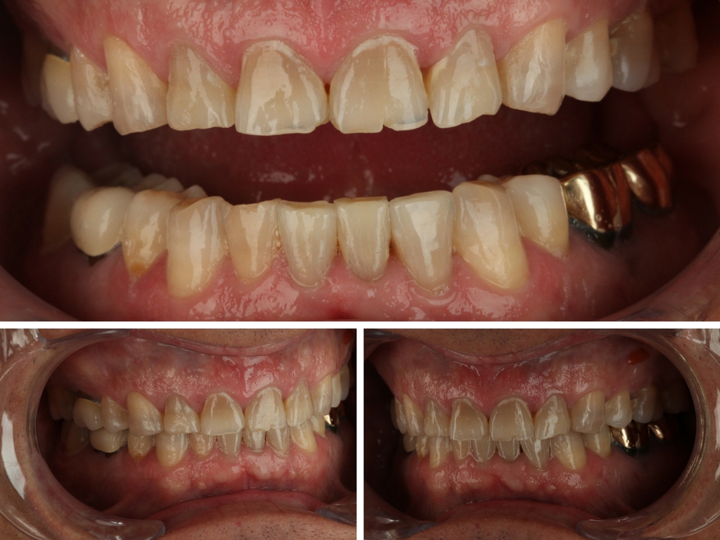 When Occlusal Instability Presents As Aesthetic Opportunity