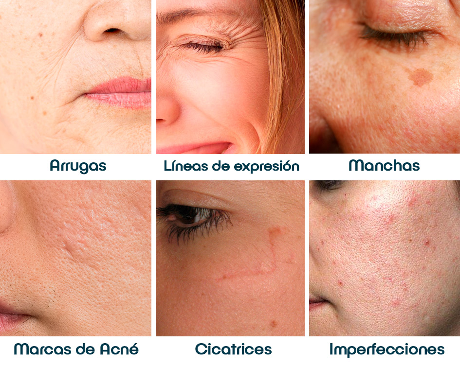 luto Intuición Cien años dermapen en rostro Estrecho de Bering