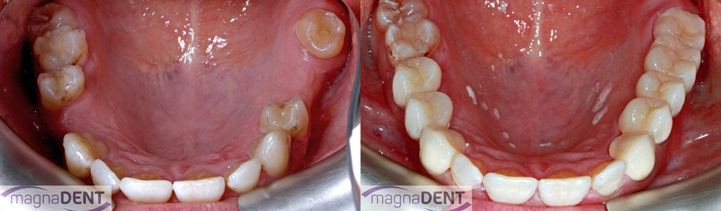 Dental Bridges types, common problems, pros and cons, cost, NHS