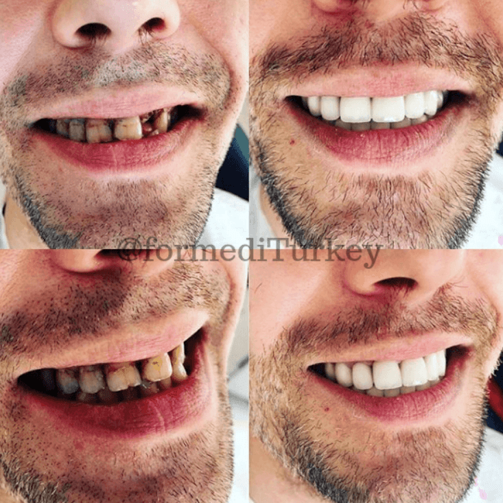 Dental Crowns types, cost private & NHS, before and after