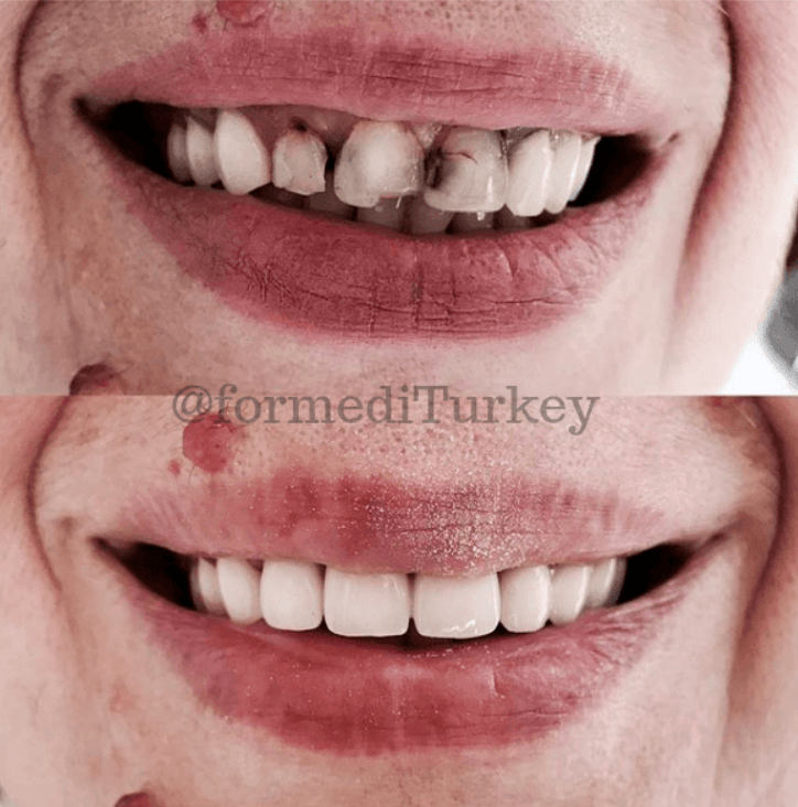 Dental Crowns types, cost private & NHS, before and after