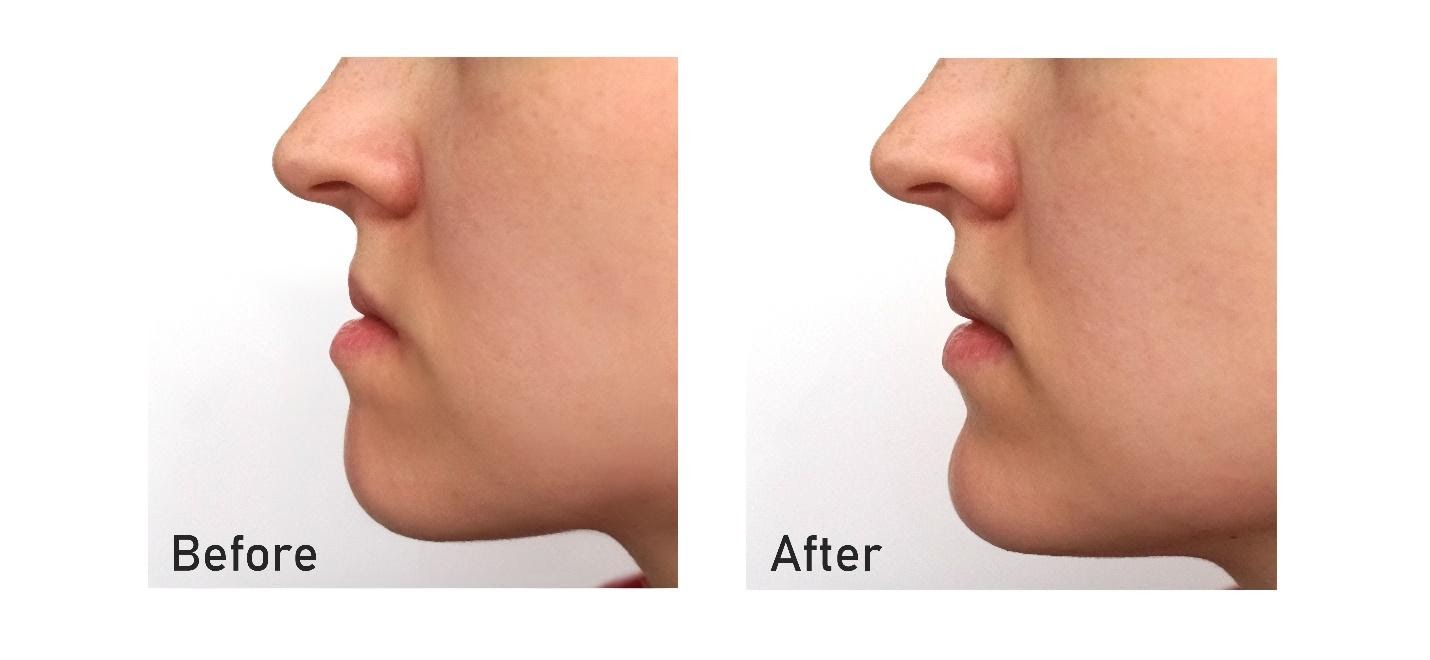Jaw Correction Surgery What Does It Do? CLINICLO