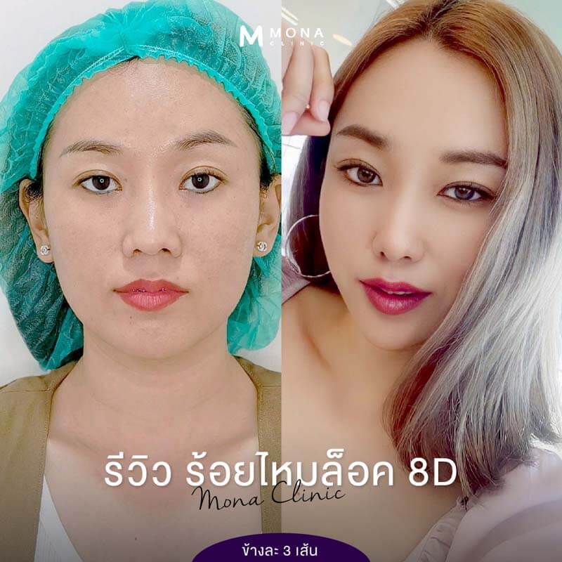 ร้อยไหม ปรับรูปหน้า VShape ยกกระชับหน้าหย่อนคล้อย Clinic Mona