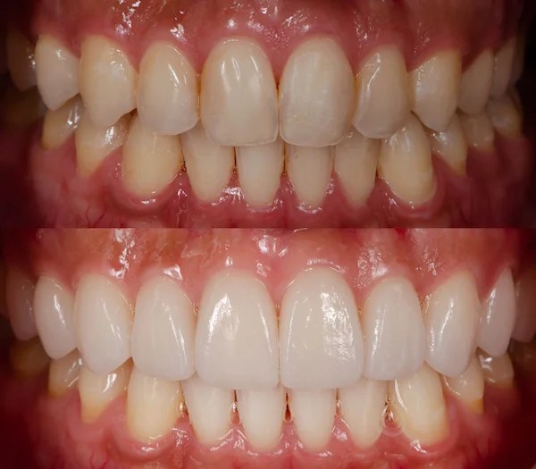 Why Are Veneers Cheaper In Turkey? Prof Clinic