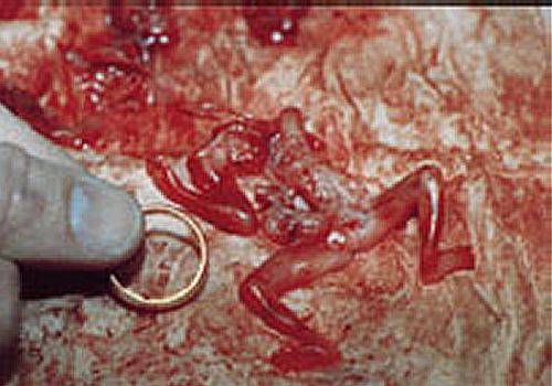 Pictures of Aborted Babies at Different Stages ClinicQuotesClinicQuotes