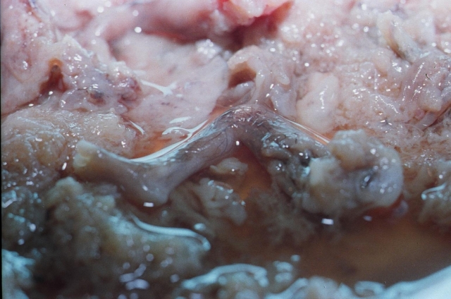 Pictures Abortion at 14 Weeks ClinicQuotes