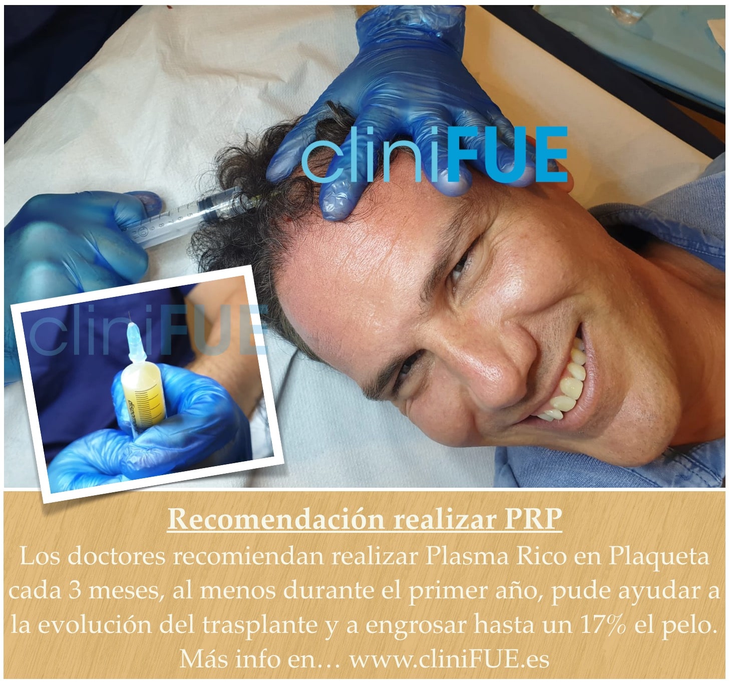 Tratamiento de Plasma Rico en Plaquetas (PRP) cliniFUE