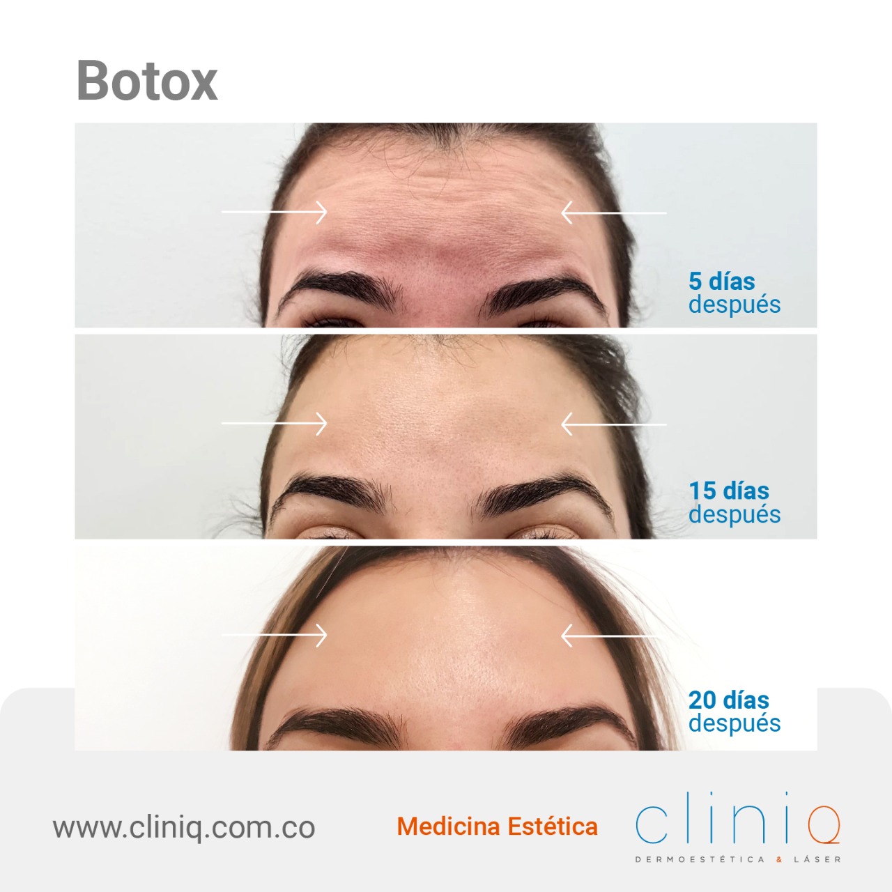 ¿Qué es el Botox y Cómo Reduce las Arrugas? Cliniq