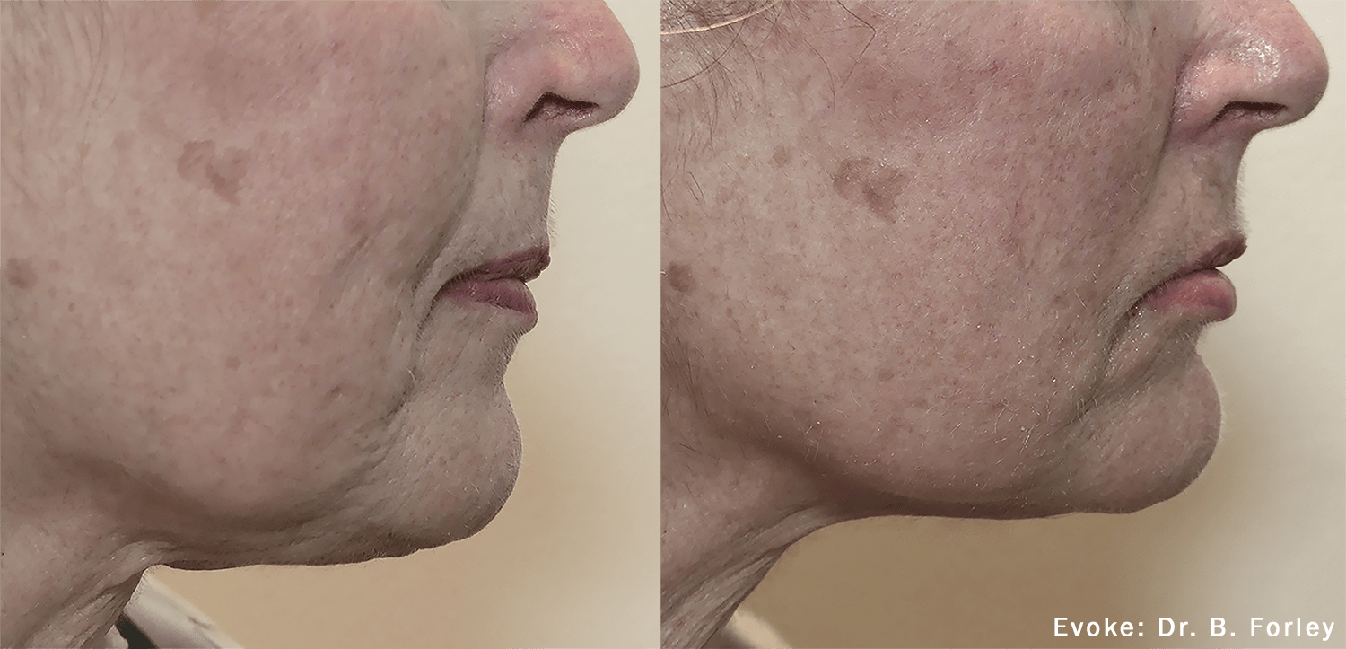 Evoke Facial Contouring Montreal Face MD