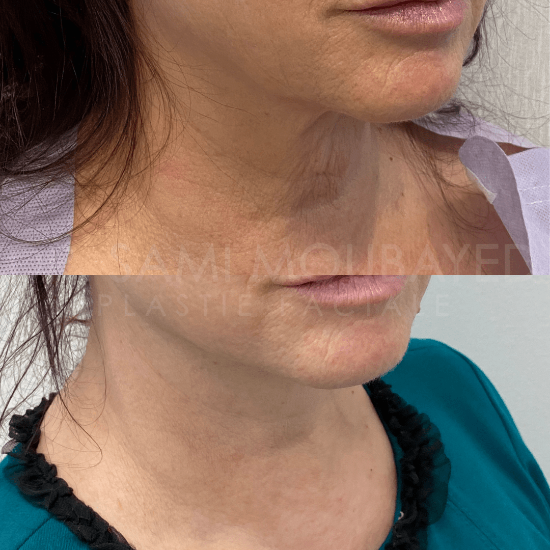 Surgical Facelift Montreal
