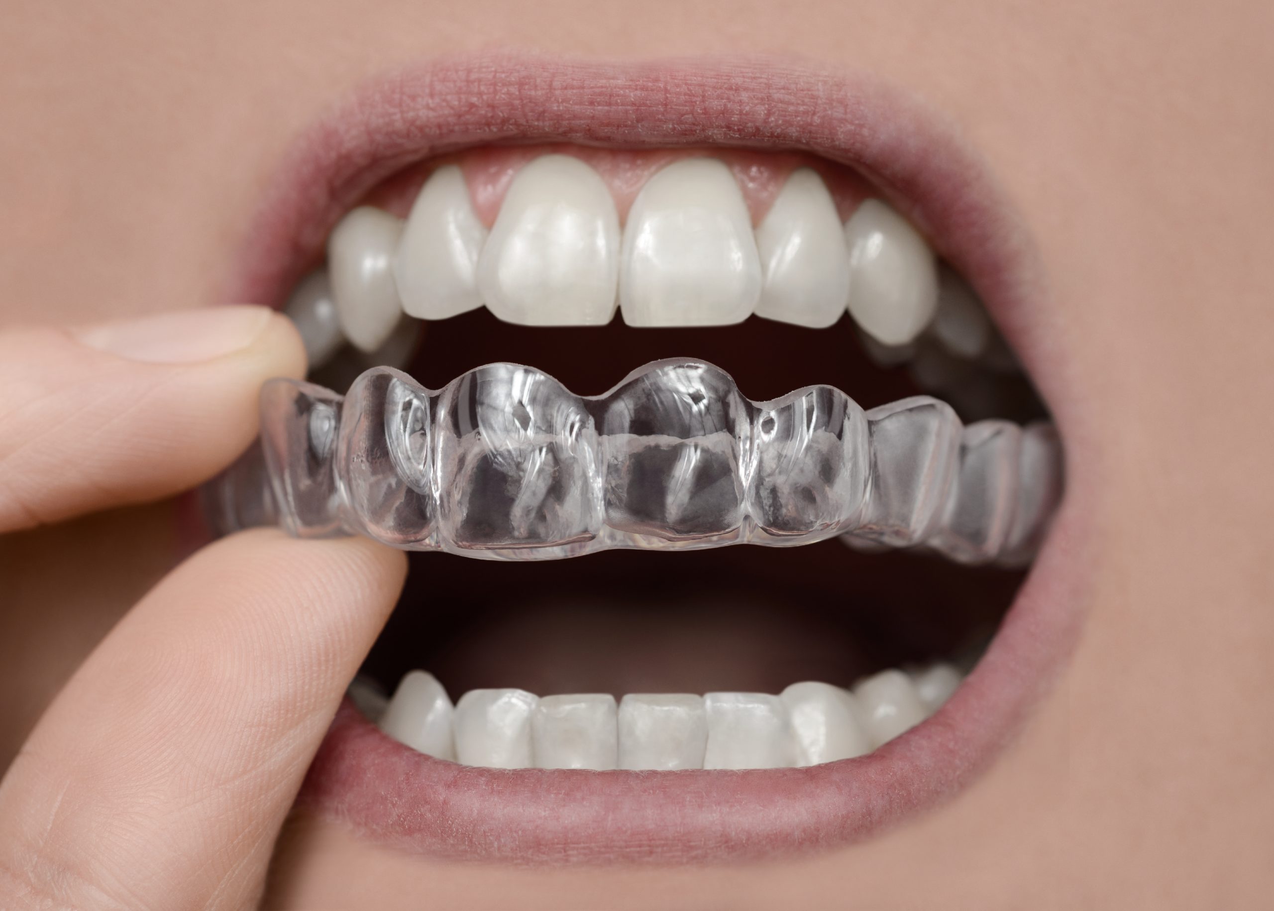 Occlusal Plate Benefits, How to Use, Cleaning & More