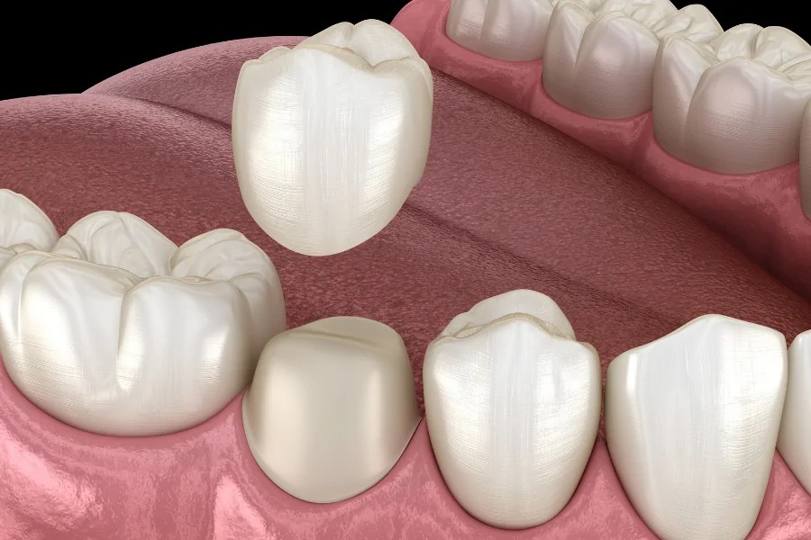Zirconium Crowns CLINIQUEPLUS