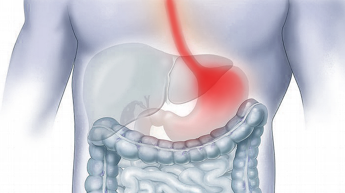 Le reflux gastrique Clinique Ressource Vitale