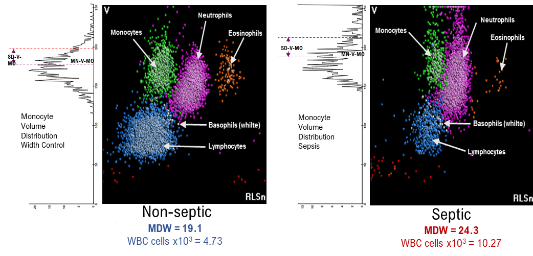 Insight into monocyte distribution width for sepsis diagnosis and COVID
