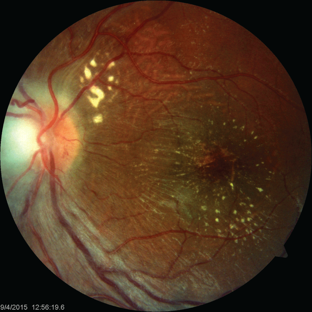 Neuroretinitis Cat Scratch Disease