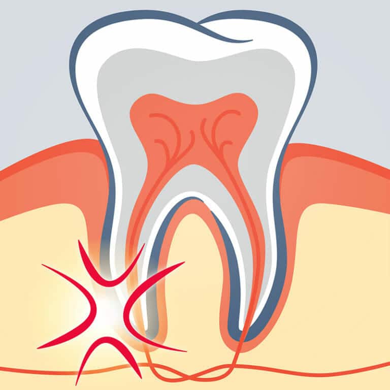 680+ Root Canal Illustrations, RoyaltyFree Vector Graphics & Clip