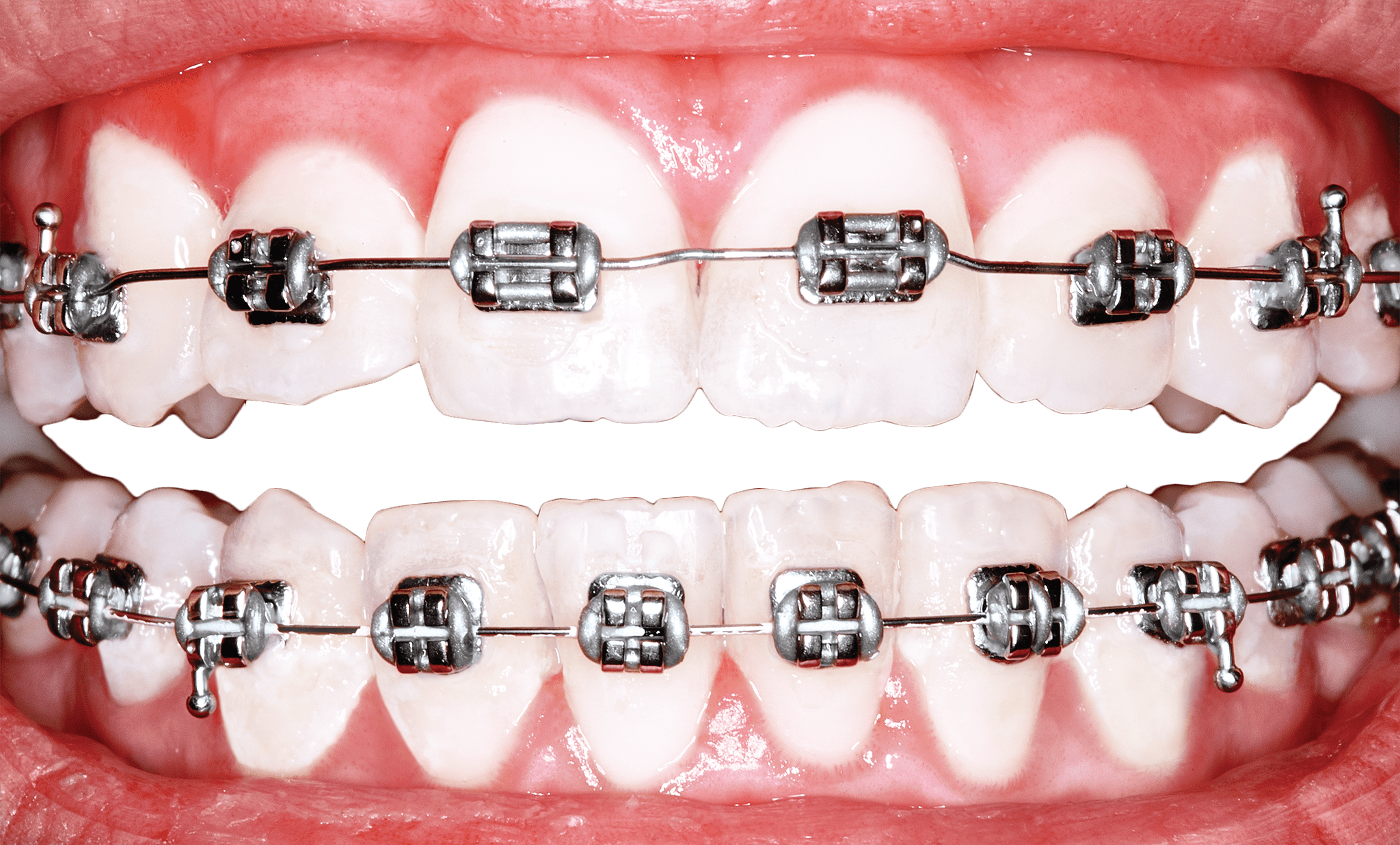 braces not on teeth Clip Art Library
