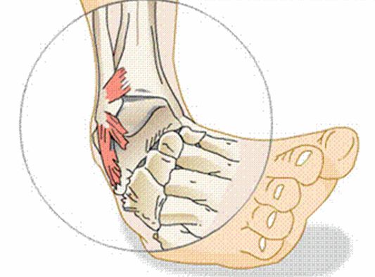Free Ankle Injury Cliparts, Download Free Clip Art, Free Clip Art on