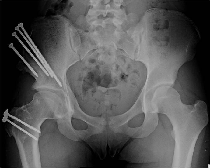 Perthes Disease St. Louis, MO Open Hip Dislocation, Missouri