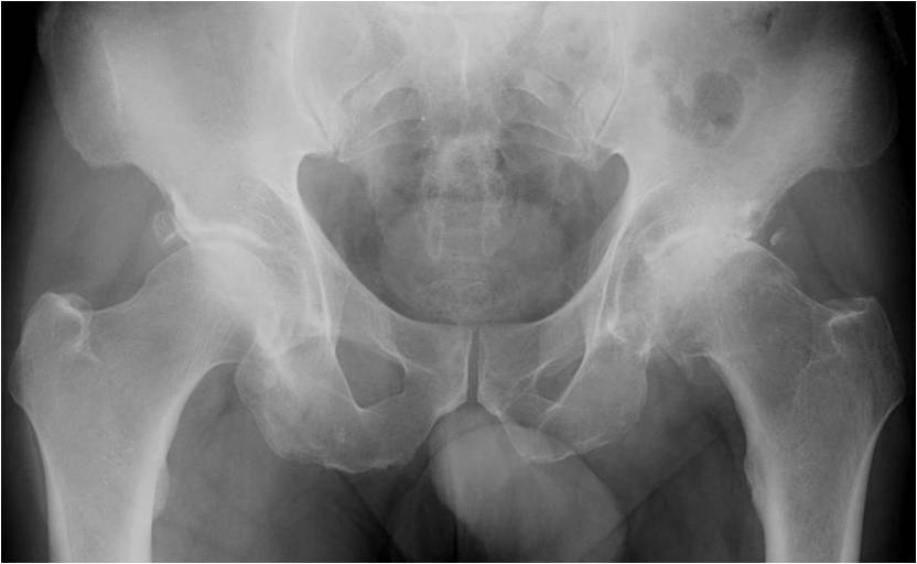 hip replacement Washington University Hospital Hip Revision Surgery