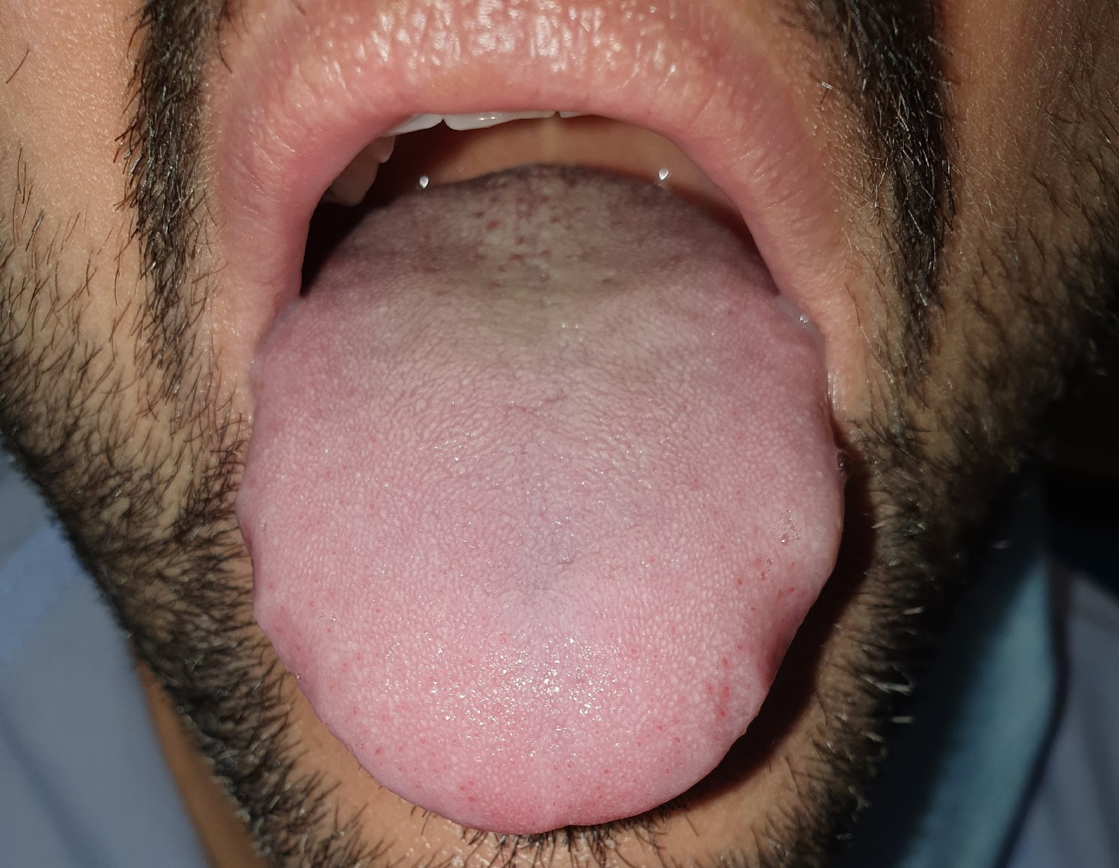 Un estudio con más de 600 pacientes describe la “lengua covid” como un