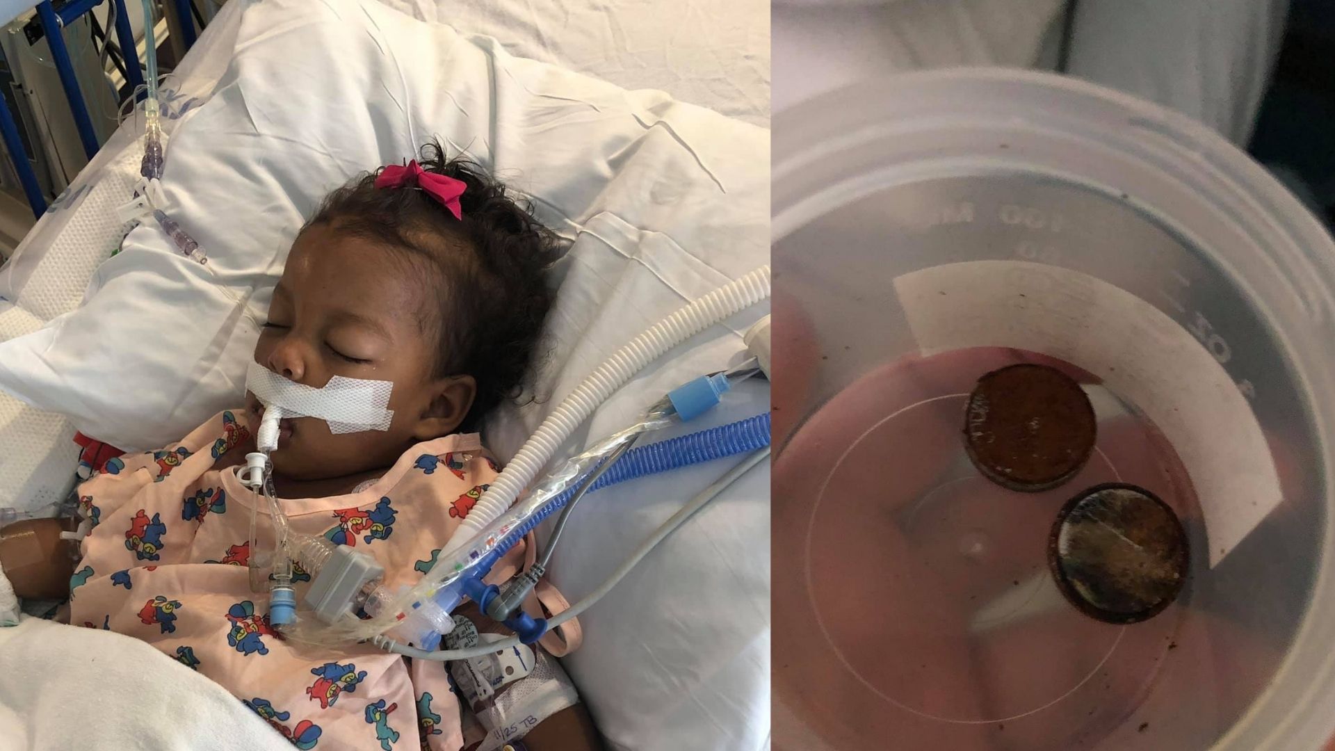 Atlanta toddler fighting for life after swallowing button