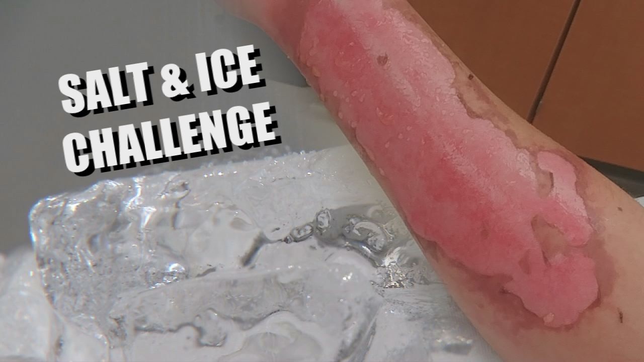 Salt And Ice Challenge' Leaves Iowa Kids With Severe Burns