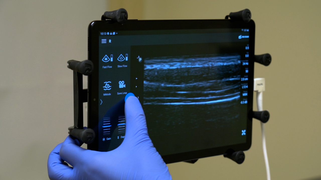 Ultrasound in Evaluating Diaphragm Dysfunction and Monitoring Treatment