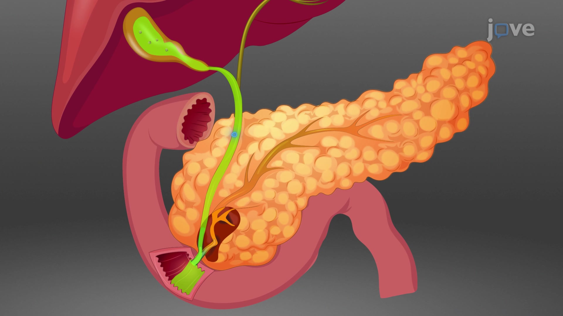 Acute Biliary Pancreatitis Model A Method to Generate Acute Biliary