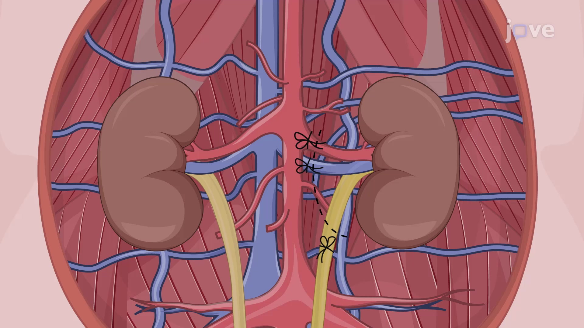 Nephrectomy in a Porcine Model A Surgical Procedure to Retrieve