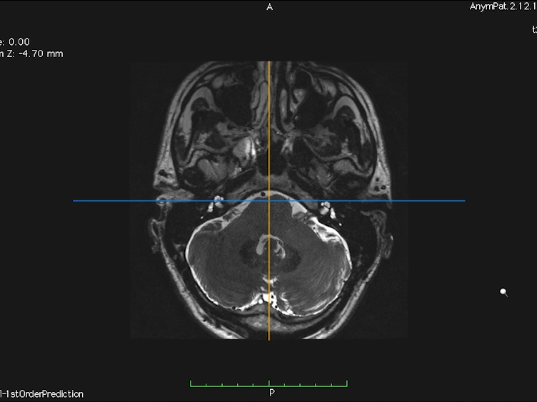Menieres Disease Attack