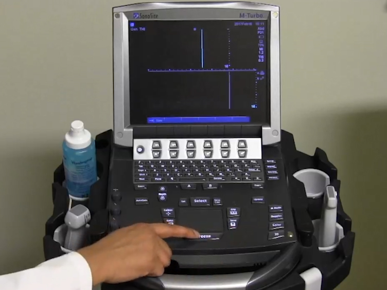 Bedside Ultrasound for Guiding Fluid Removal in Patients with Pulmonary