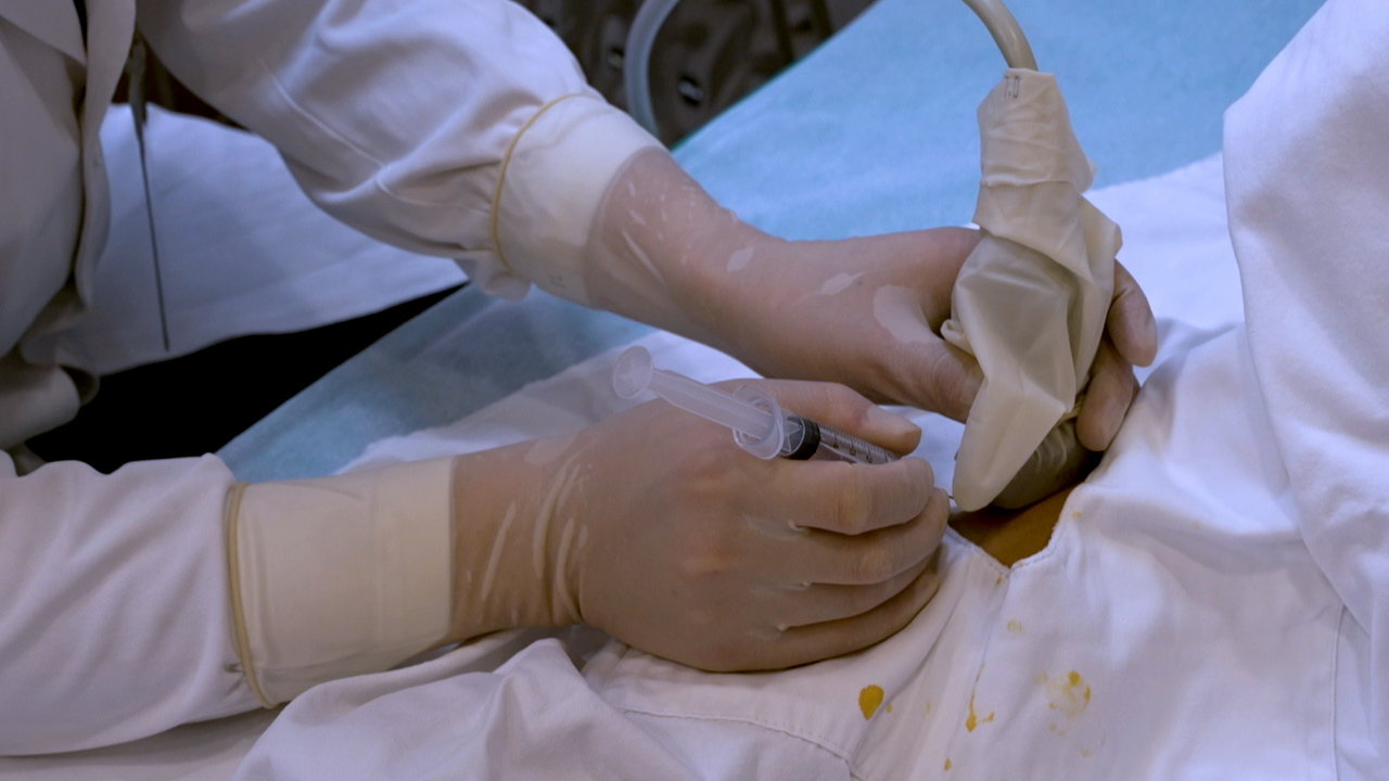 Author Spotlight UltrasoundGuided Needle Release Combined with