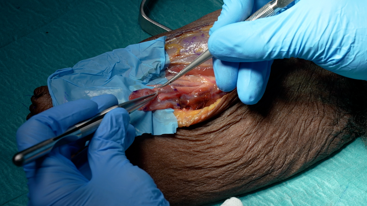 Author Spotlight Regenerative Peripheral Nerve Interface (RPNI