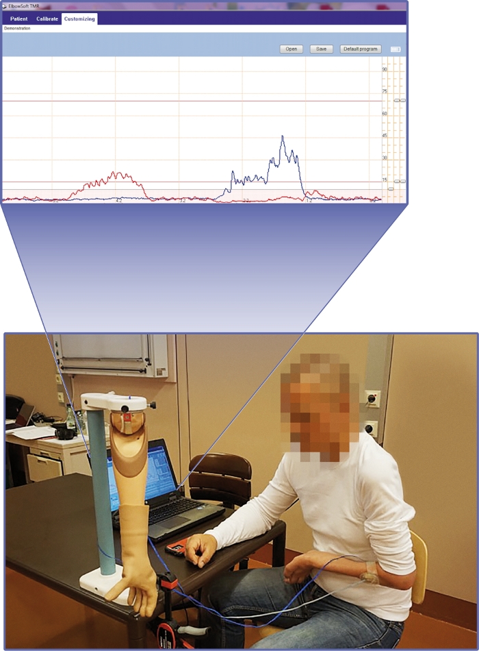 Surface Electromyographic Biofeedback as a Rehabilitation Tool for Patients with Global Brachial