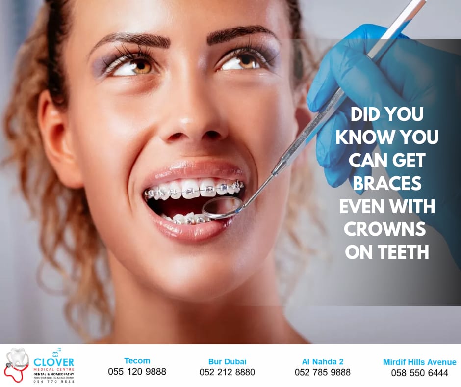 DID YOU KNOW YOU CAN GET BRACES EVEN WITH CROWNS ON TEEETH? Dr Sameer