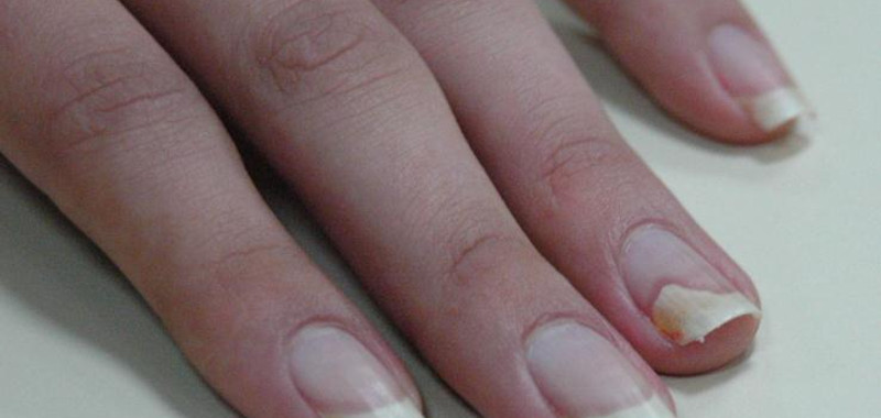 Micose nas Unhas