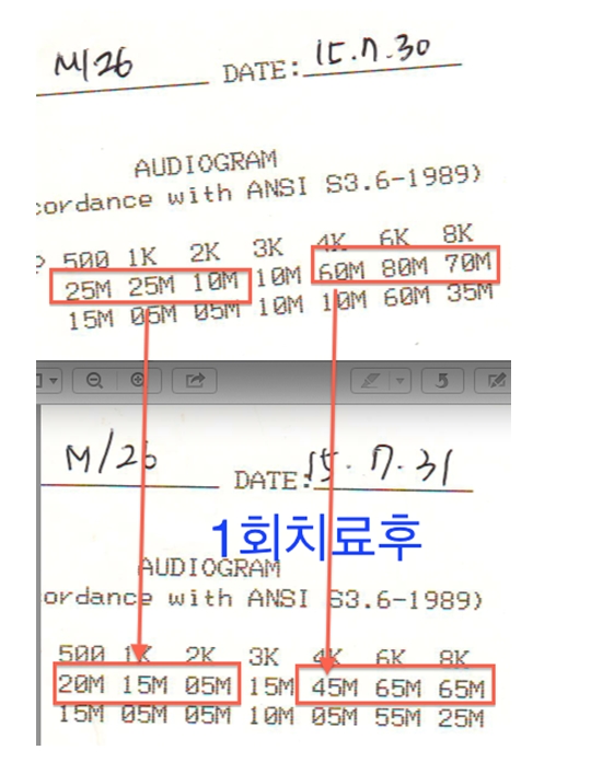 Auditory cell regenerative therapy and tinnitus treatment testimonial