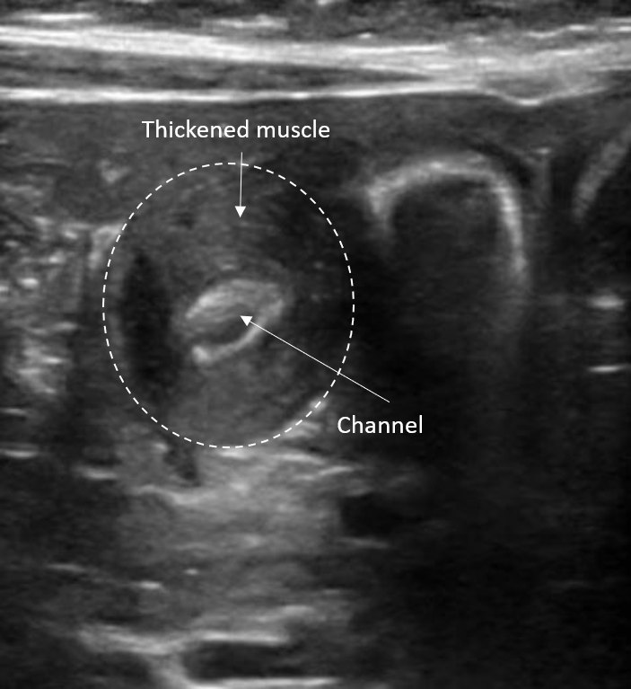 Pyloric Stenosis Carolinas Pediatric Emergency Medicine Fellowship