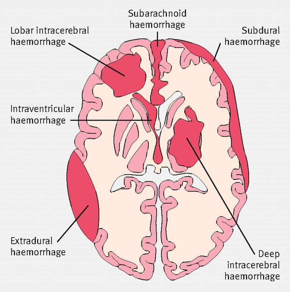 Bleeding Within Meninges and How to Treat It Platform CME