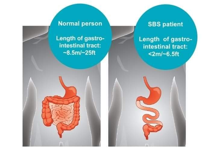 Do you know,What is Short Bowel Syndrome? Platform CME