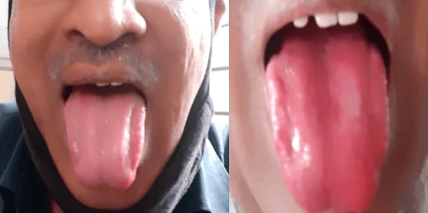 Redness on the sides of tongue, What is the diagnosis? CME INDIA