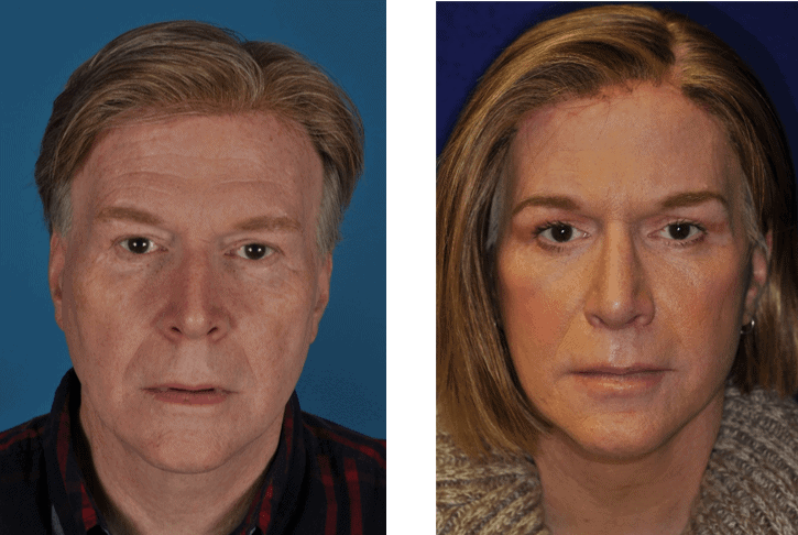 Facial Feminization Dr. Ali Totonchi