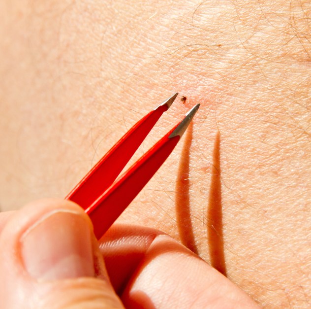 How to Safely Remove a Tick from Skin