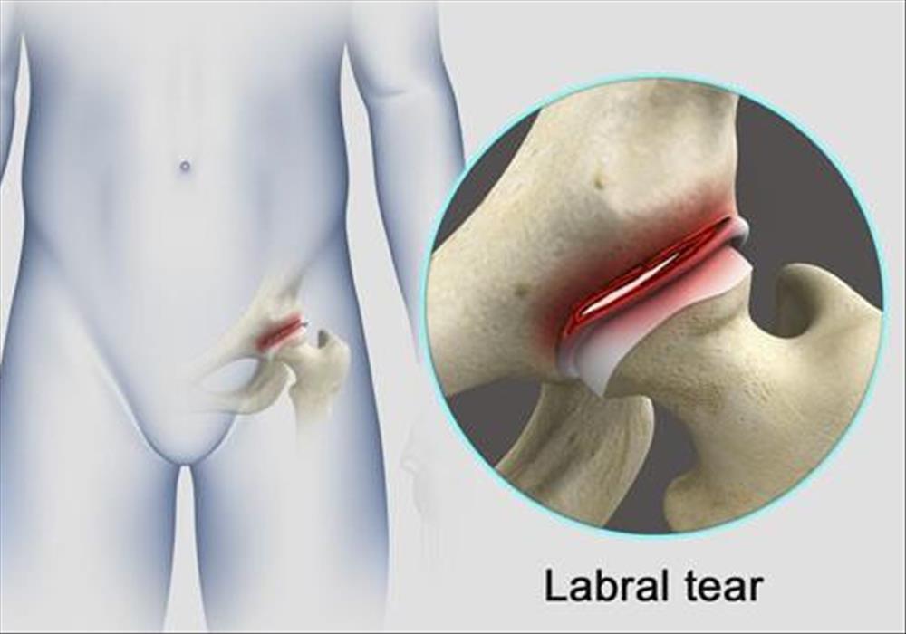Hip pain due to labral tear Herald