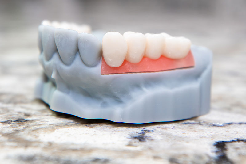 Full & Partial Dentures Lexington, KY iDENTity Dental Studio
